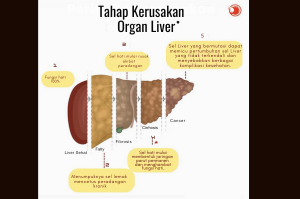 tahap-penyakit-hati-berlemak-berpotensi-kanker