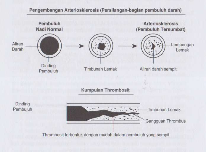 terbentuknya-arteriosklerosis